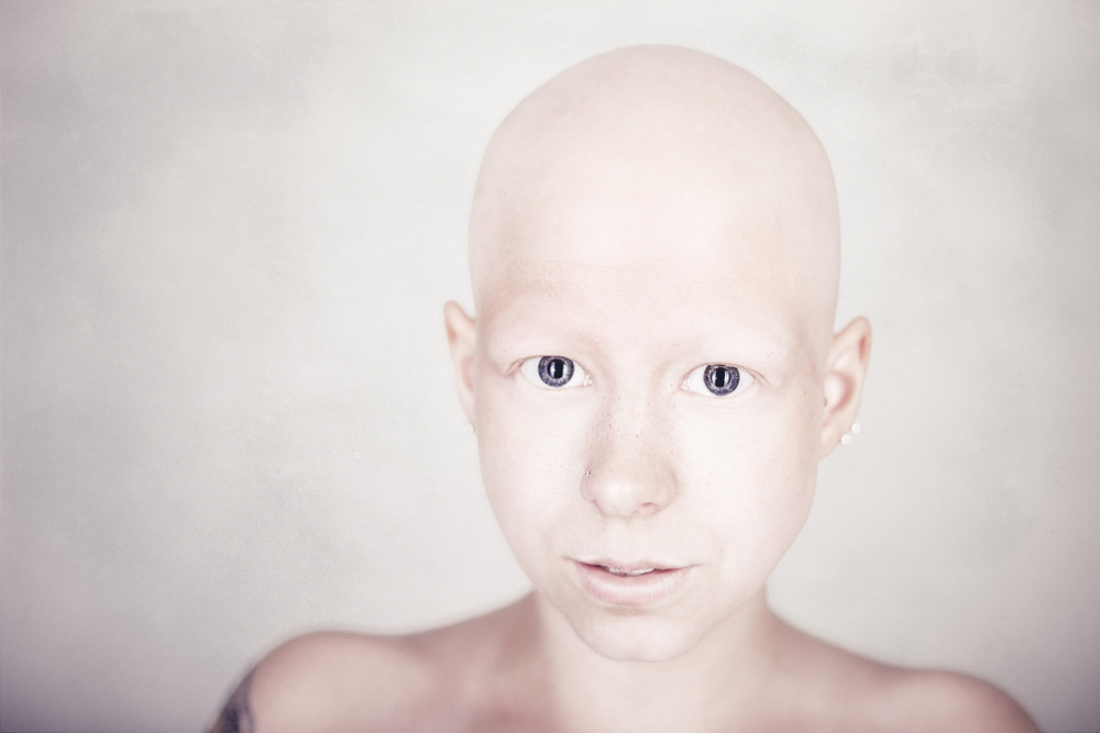 Alopecia universalis from Kimmo Lundahl